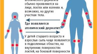 Атопический дерматит: как помочь малышу? (часть 1)